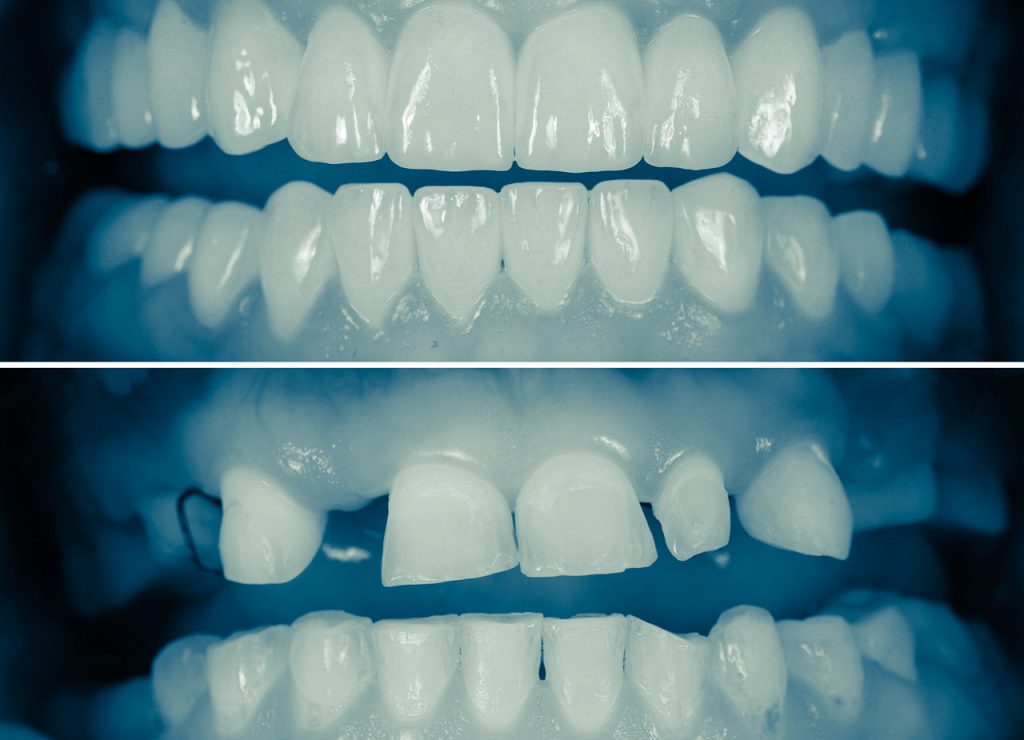 image of uneven teeth and then corrected teeth