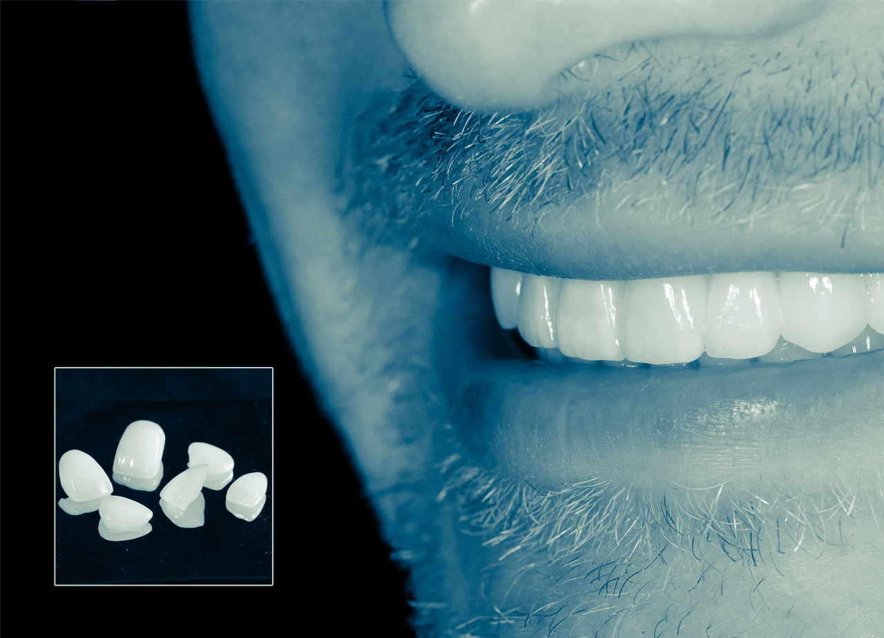 Crowns, Bridges, and Veneers