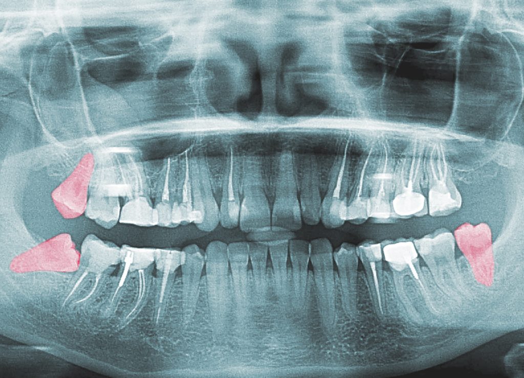 xray of full set of teeth